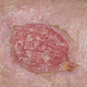 Vrsta kožnega raka, ki prizadene zgornjo plast kože