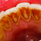 Vas moti zobni kamen, ki nenehno nastaja in povzroča težave z dlesnimi?